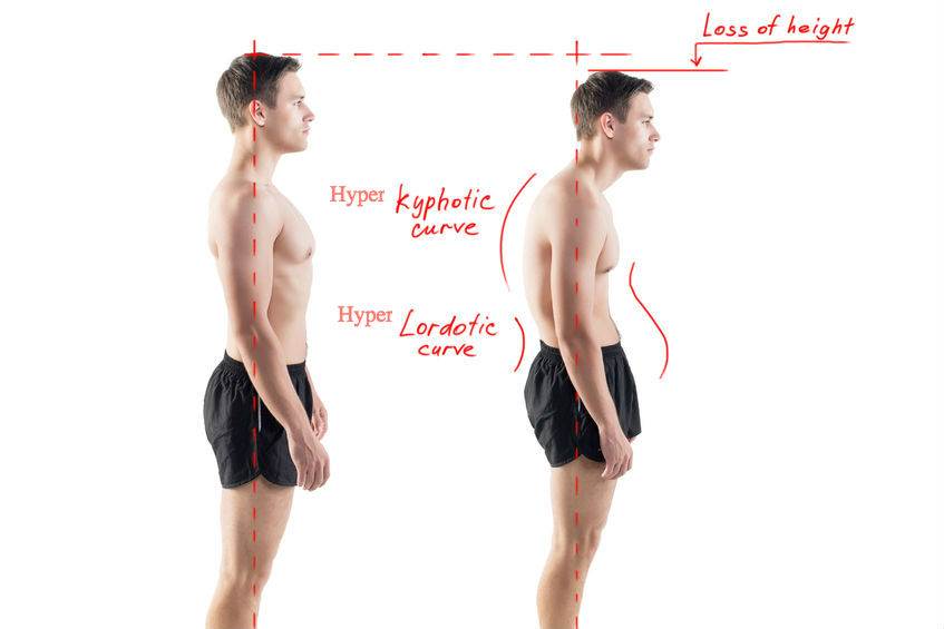 It's Not Too Late to Correct Poor Posture