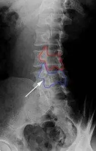 Scotty Dog X-ray | Dr Ken Nakamura downtown Toronto Chiropractor